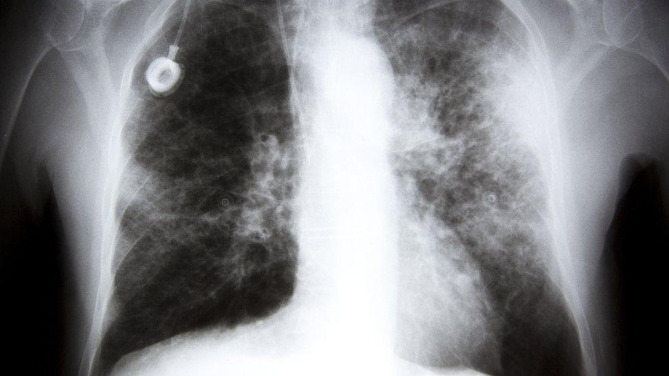 Lung cancer x-ray