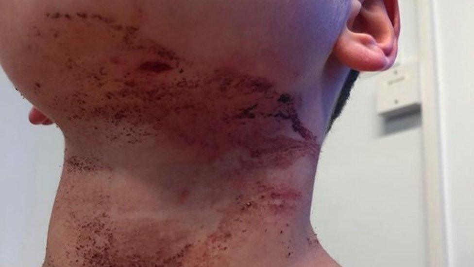 Lucas Nicholls' wounds