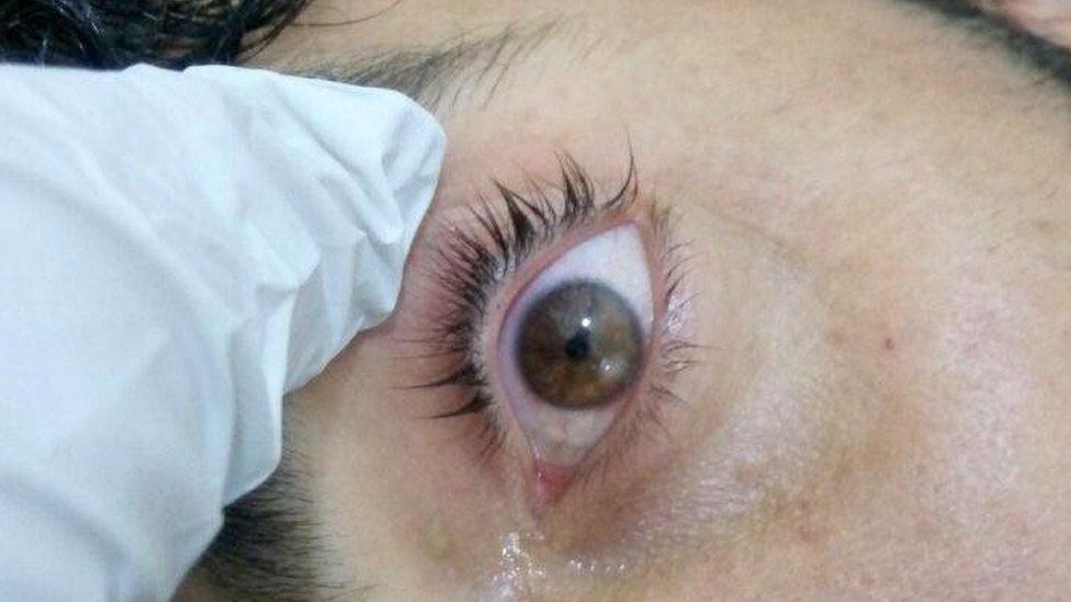 Severely constricted ("pinpoint") pupil of a man injured in attack near Latamina on 30 March, according to the Syrian American Medical Society