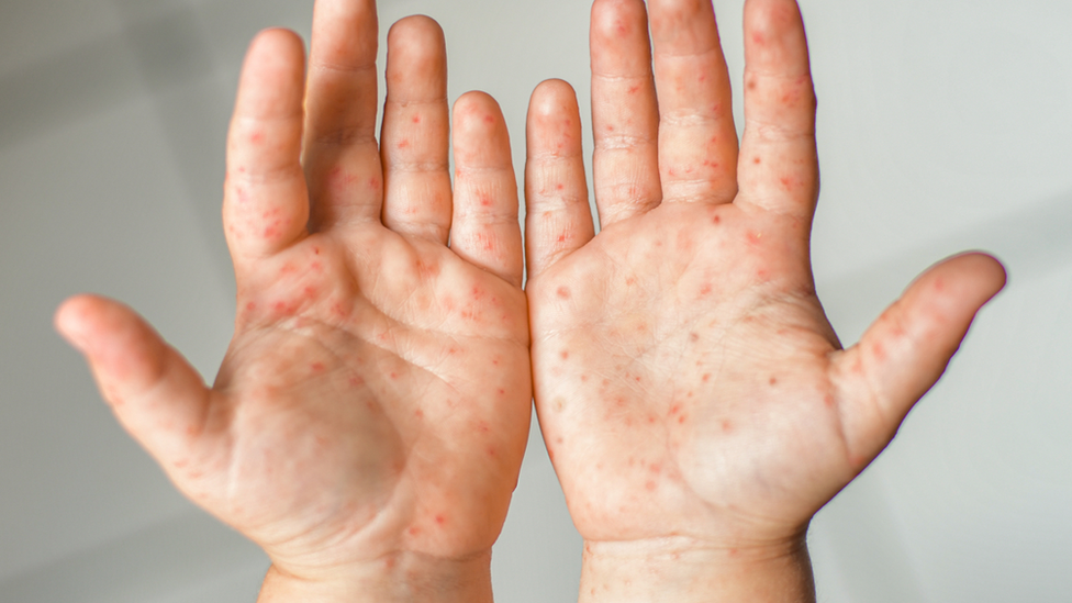 Cocksackie hand, foot and mouth rash