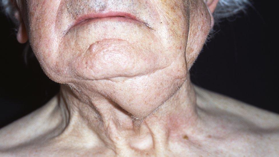 elderly man with neck tumour