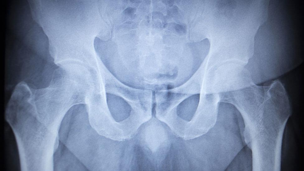 Hip x-ray