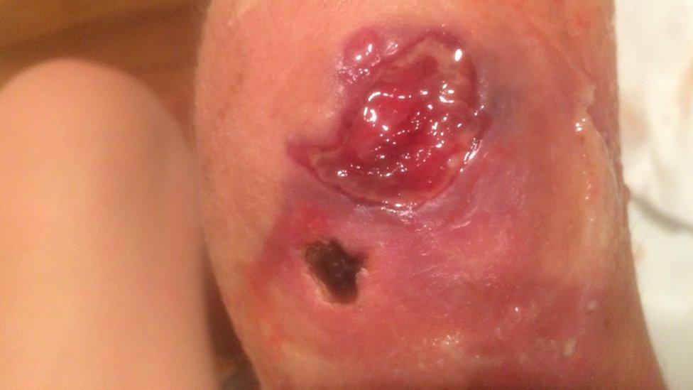 A knee with a Buruli ulcer