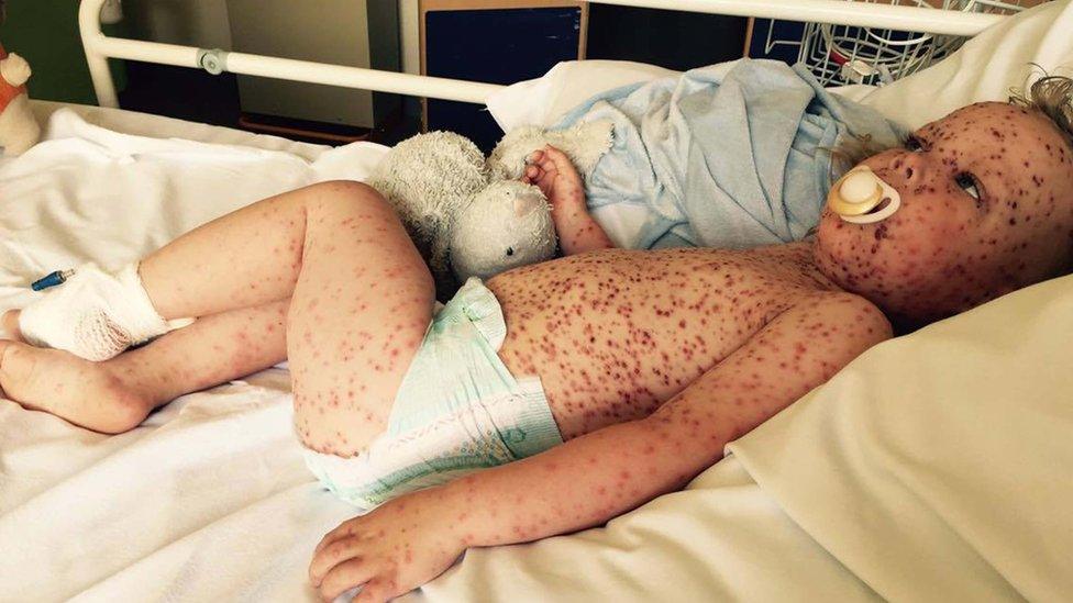 Jasper Allen, from St Neots, who had severe chickenpox