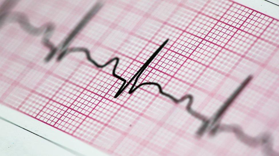 ECG trace