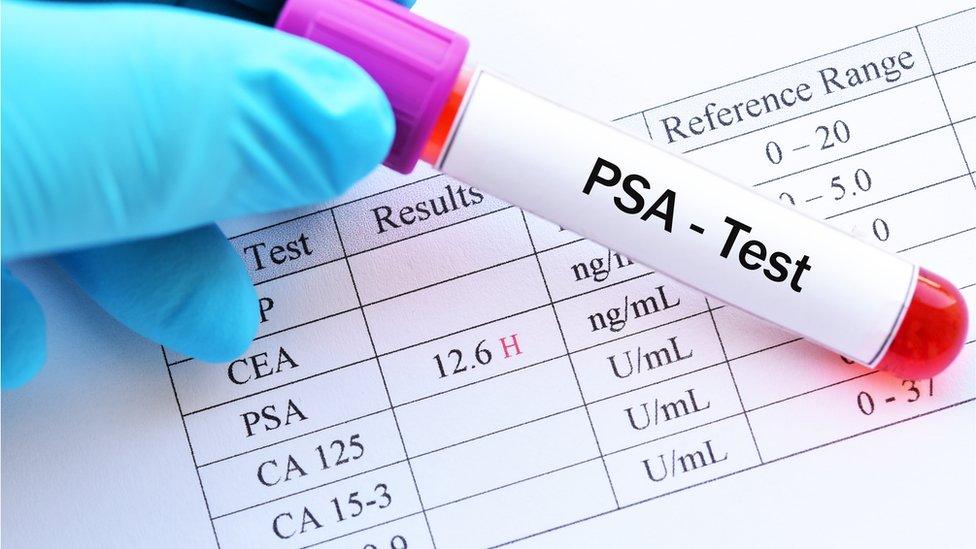 The PSA test is not a reliable test for prostate cancer