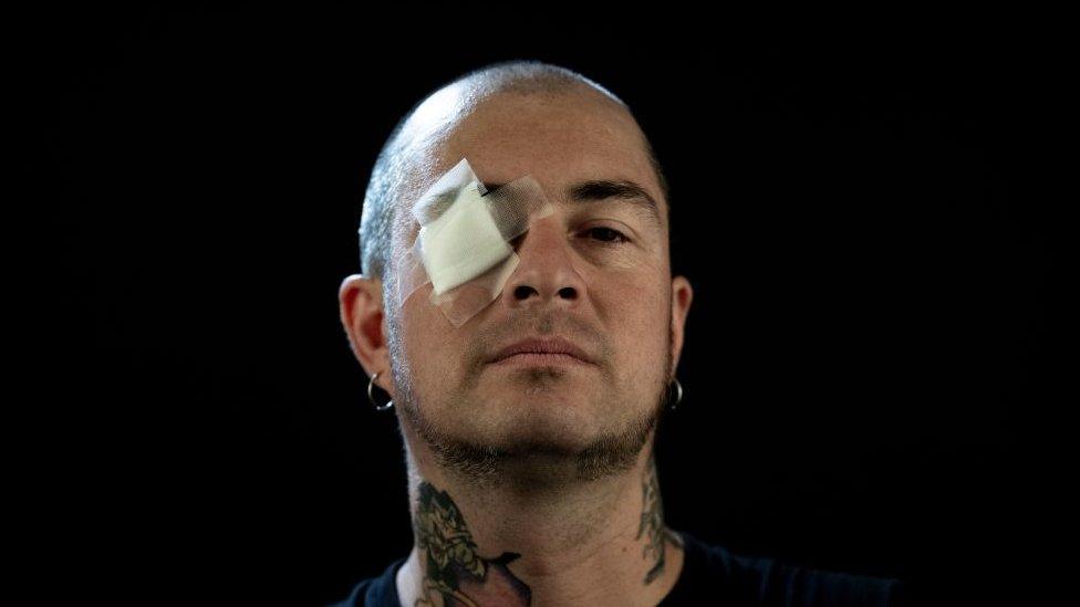 Chilean musician Sergio Concha, 42, who was reached by a pellet from the police during a protest and lost his right sight, poses for the camera in Santiago, on December 4, 2019.