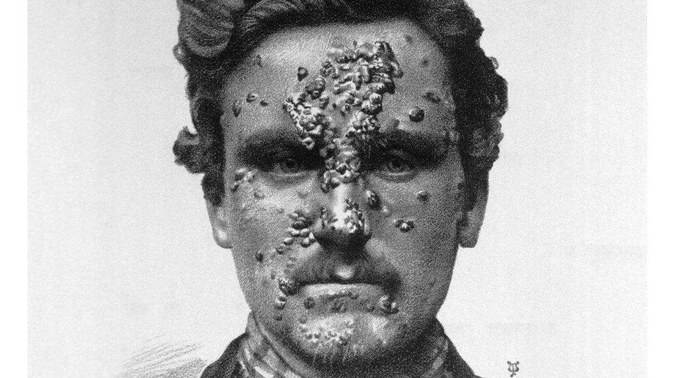 A syphilis sufferer before the days of antibiotic treatment