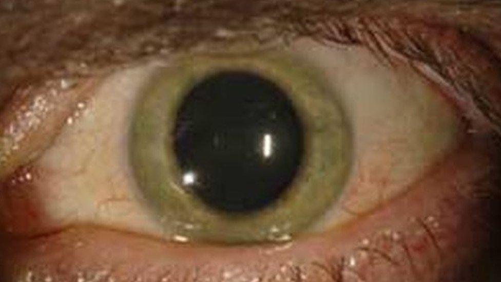 Dr Crozier's eye