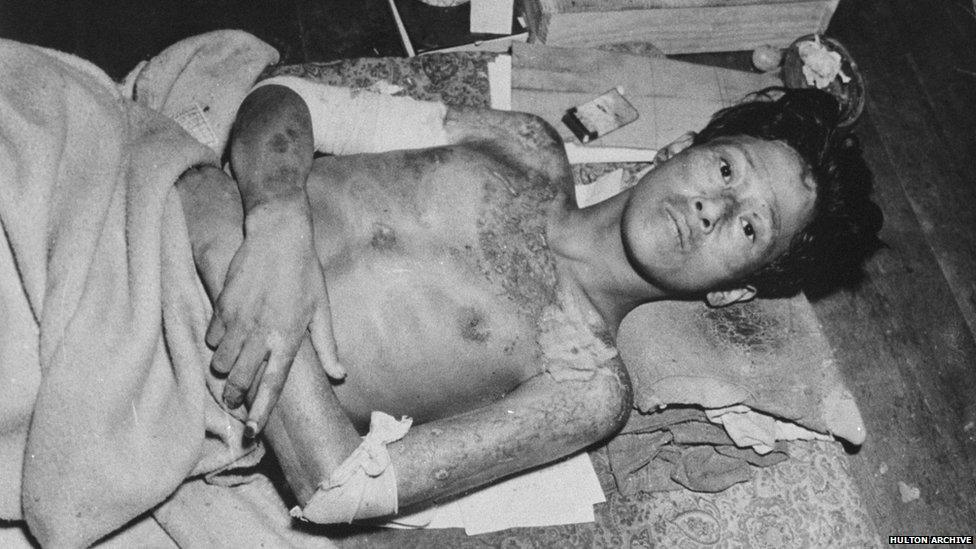 A victim of the atomic bomb explosion in 1945 over Nagasaki, Japan.