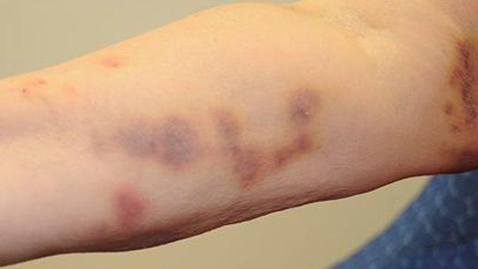 Bruising on Lis Culshaw's arm