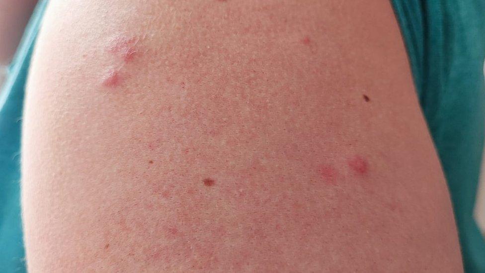 Bed bug bites on Vicky Hill's shoulder