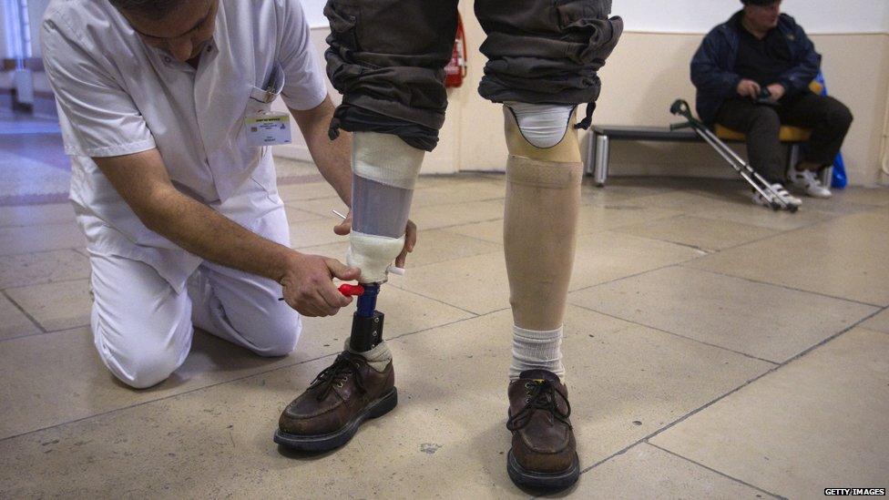 US army veteran gets prosthetic legs adjusted