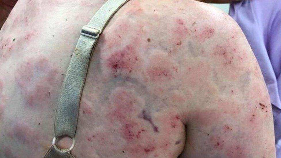 Bruising and scrapes are seen across Fiona Simpson's back