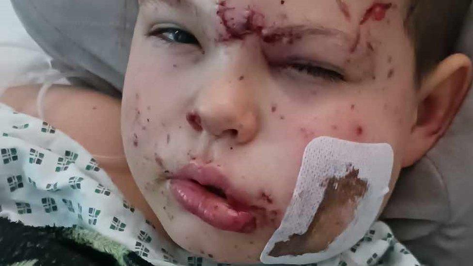 Bradley had shrapnel removed from his face and near his eyes. He is pictured in bed with facial injuries and a plaster on his cheek