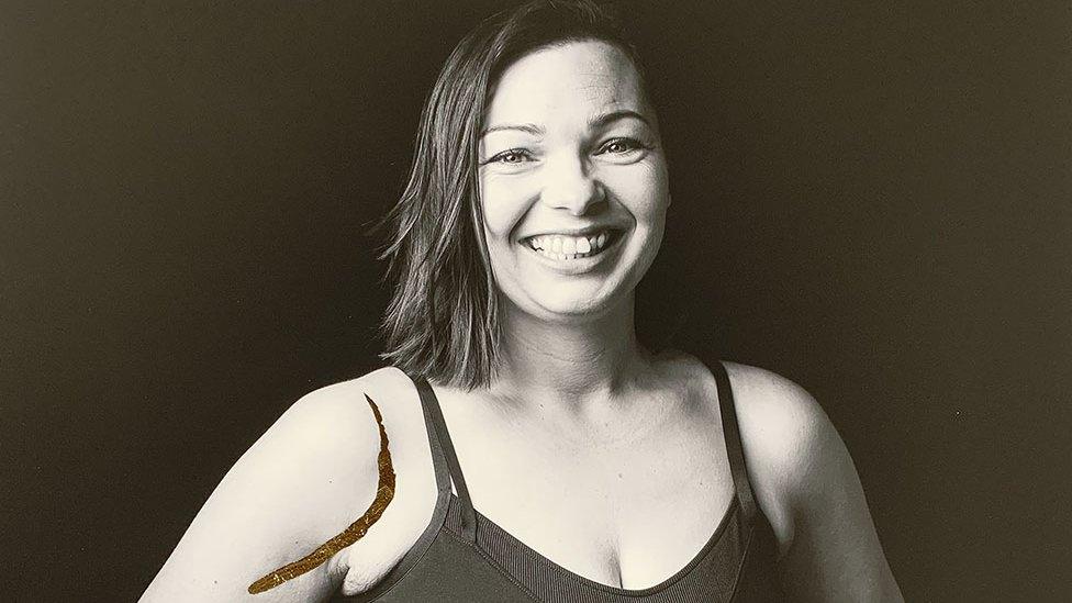 A black and white image of a female patient with a scar on her shoulder filled in with gold leaf