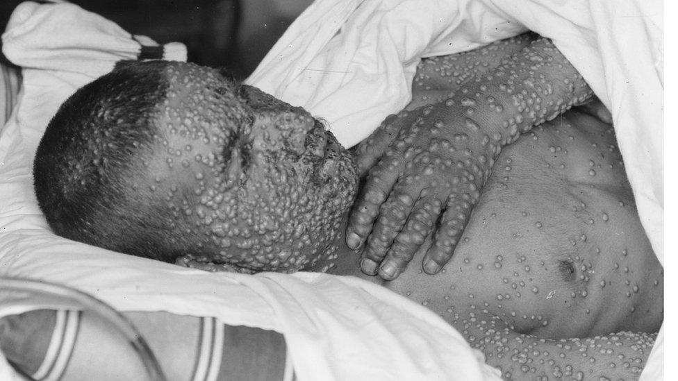 A smallpox victim