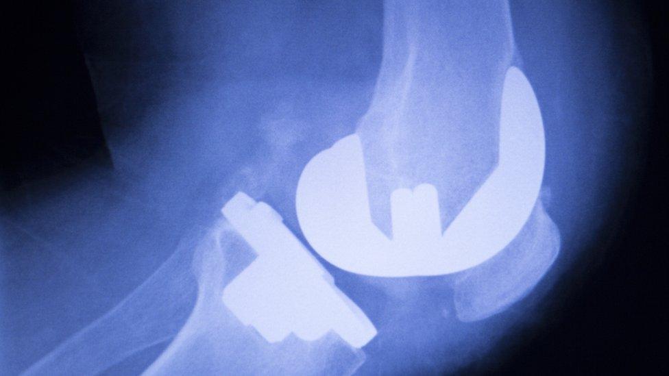 Knee replacement x-ray