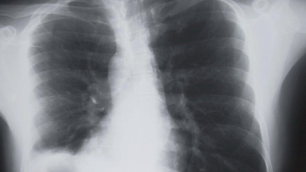 Chest x-ray