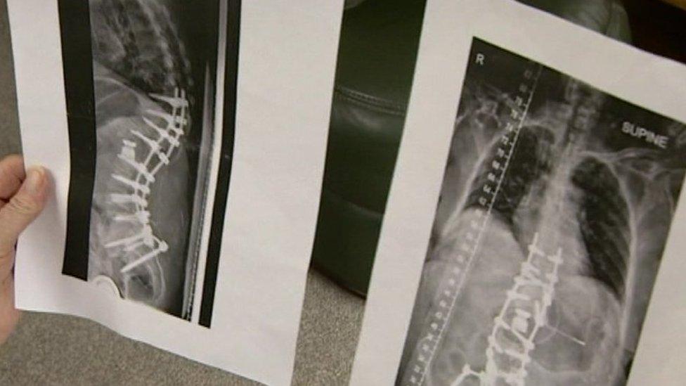 Judith Mills holding X-rays of her spine