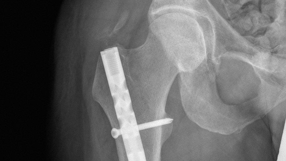 Data recording the outcomes of quarter of a million hip fracture patients was used in the Southmead Hospital study