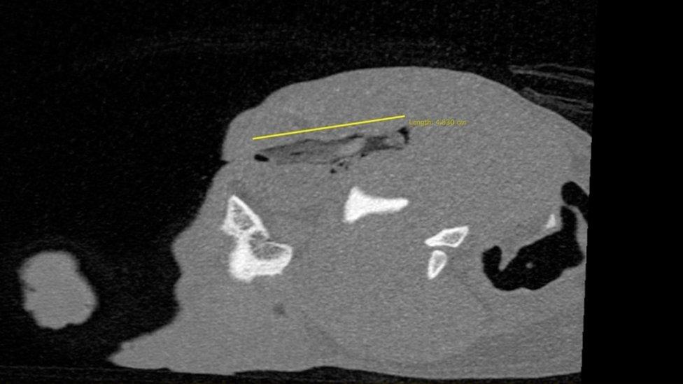 CT scan of skull showing stick