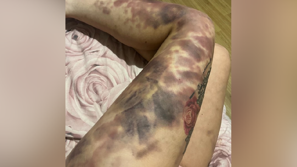 Bruises