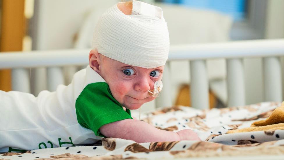 Kobi has a bandage wrapped around his head. He is lying on his tummy and is holding his head up. He is wearing a green and white t-shit. He has blue expressive eyes. there is a feeding tube in his nose.