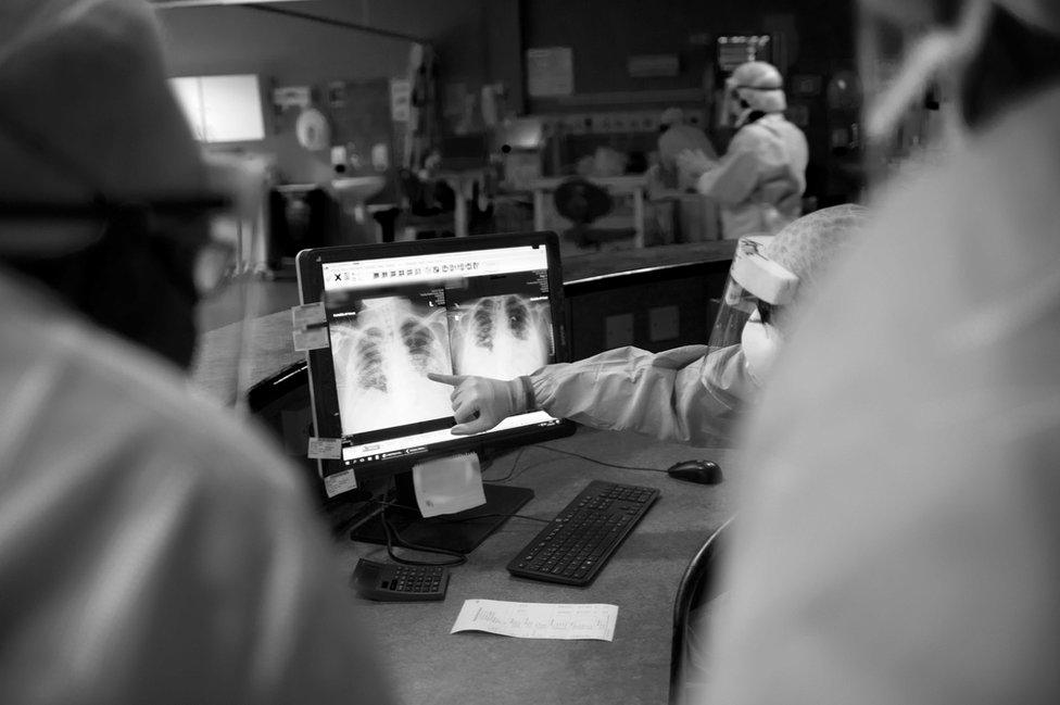 A patient's X-ray is examined for fluid, to help decide if they can be taken off a respirator.