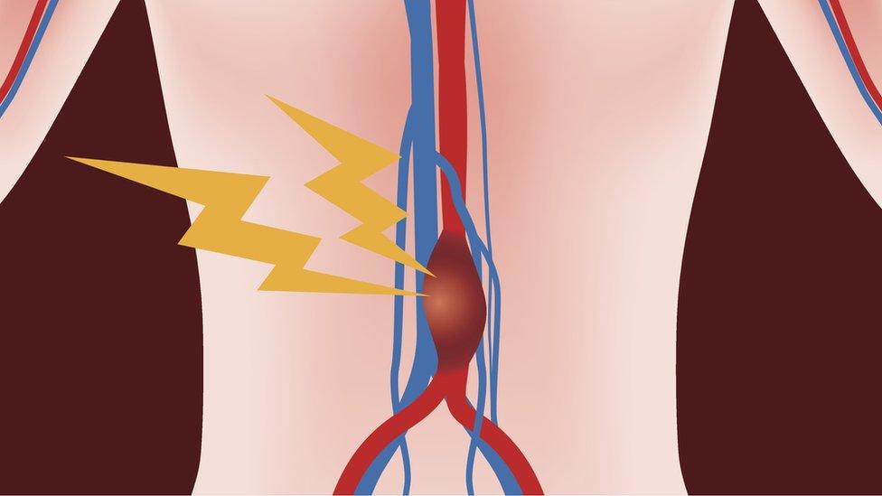 Graphic of aortic aneurysm