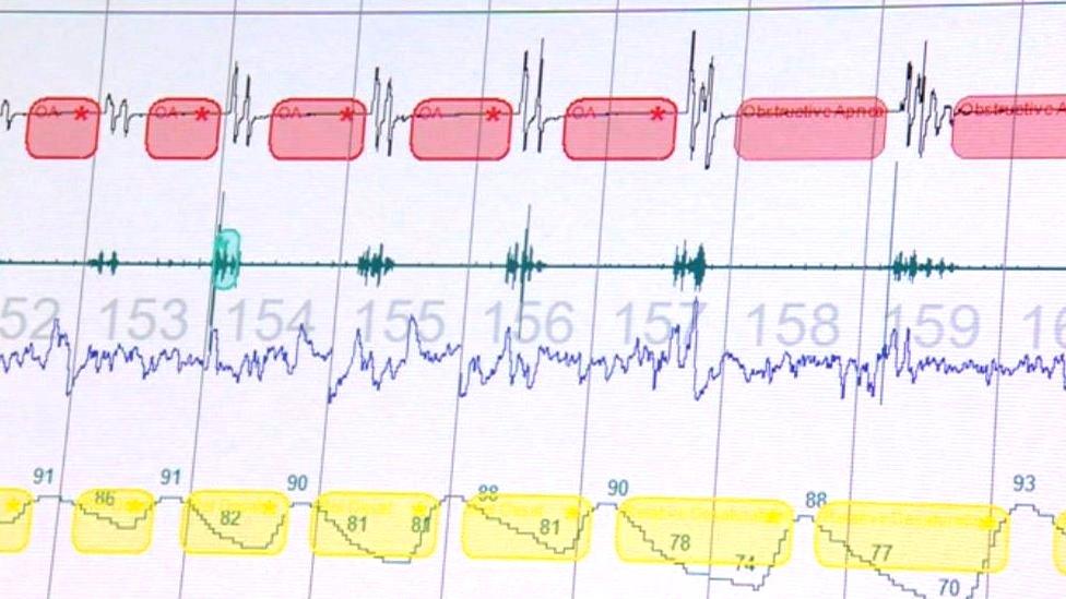 Computer screen with sleep test results on.