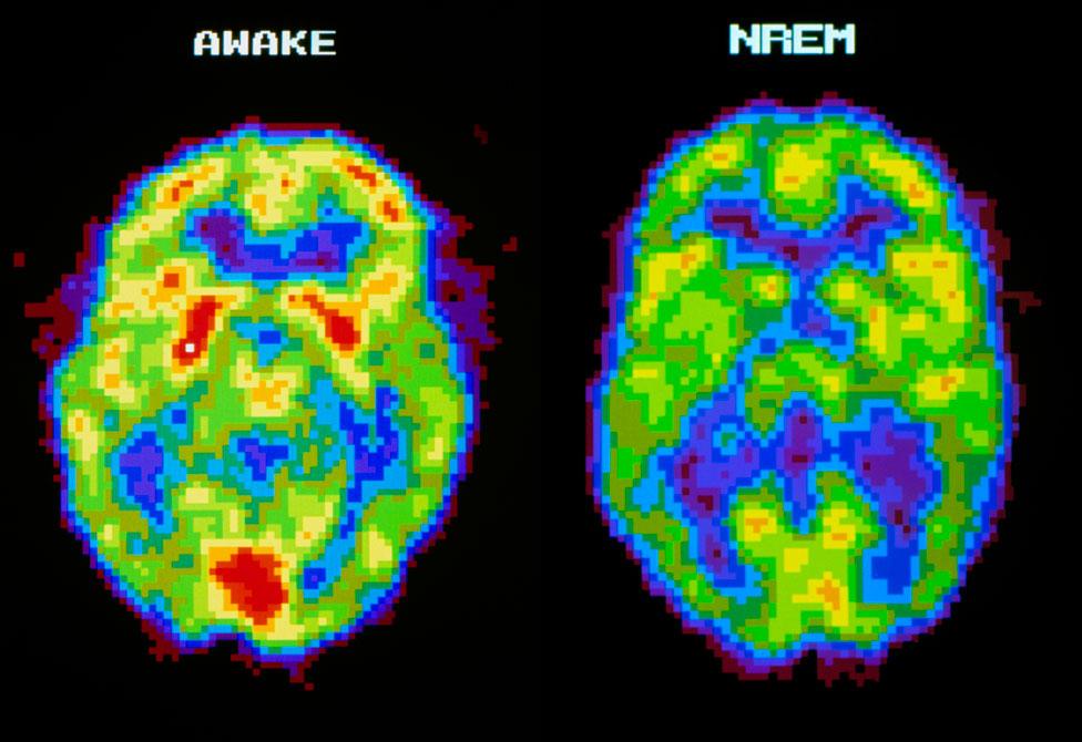 When sleepwalking parts of the brain show activity similar to that of a waking brain