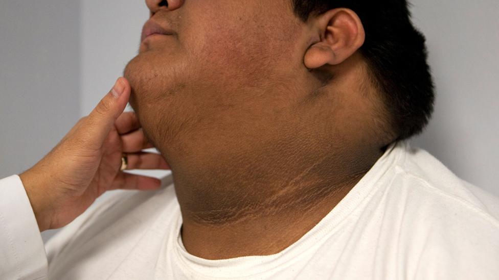 Acanthosis Nigricans