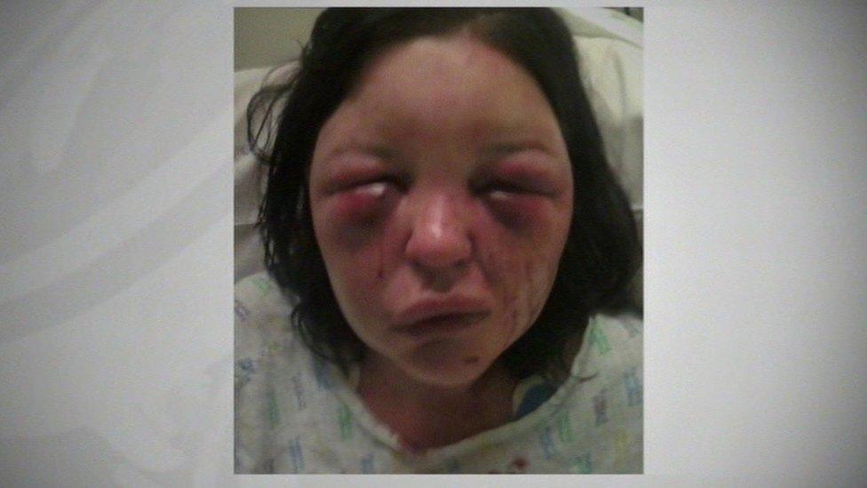 Terri-Louise Graham after she was attacked by her ex-partner