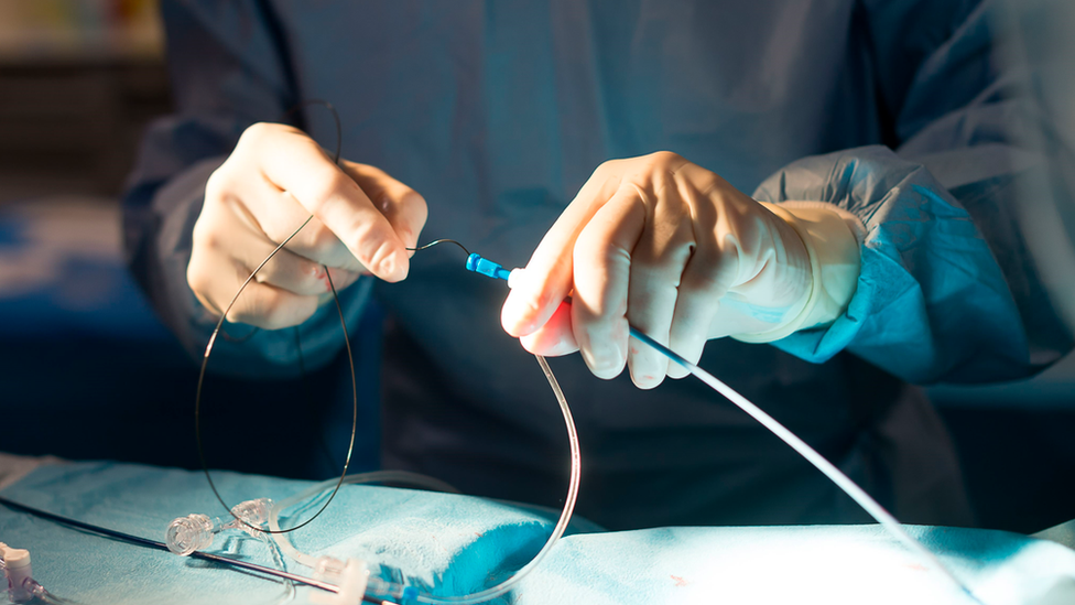 A thrombectomy procedure being carried out