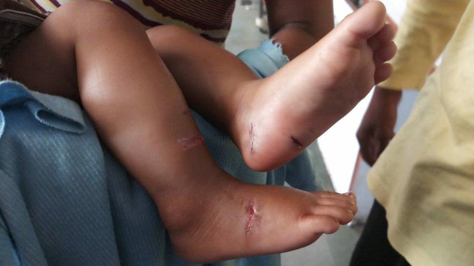 The four-month-old baby's injuries