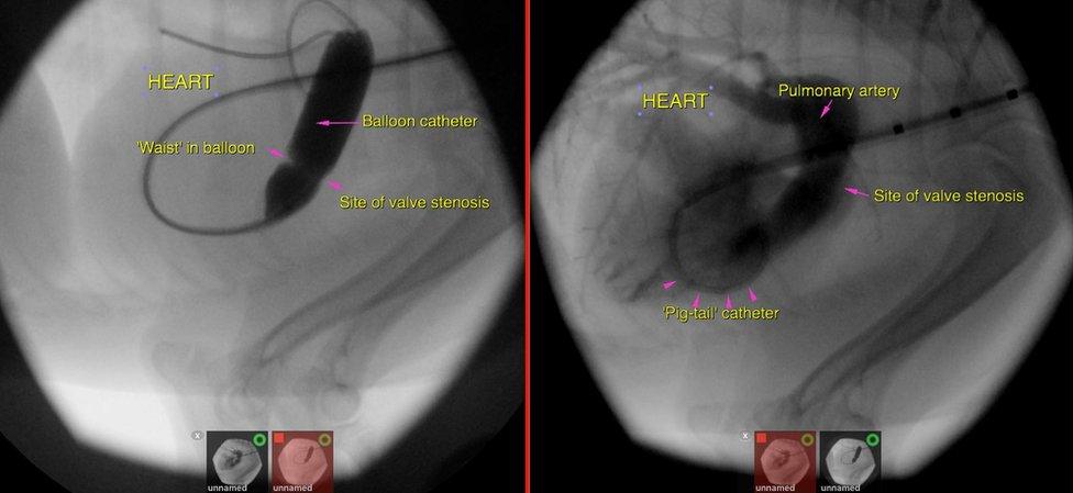 Images of balloon catheter in dog