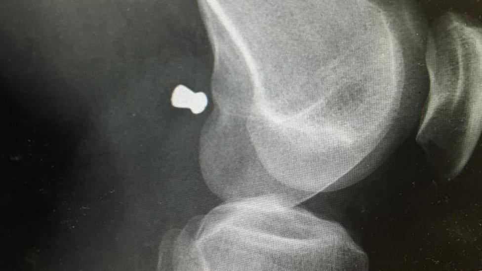 X-ray of Jordan Fyfe's injury