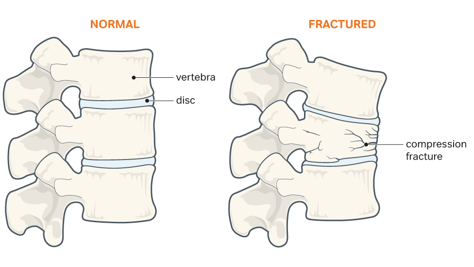 Fractures