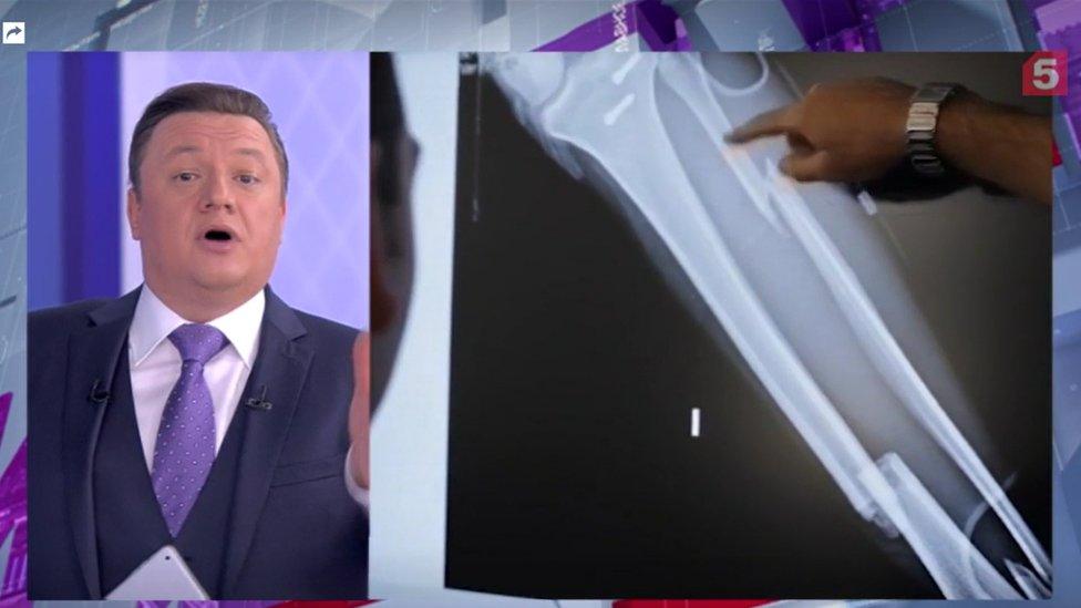 Russian TV presenter pictured talking on the left and an image of a person pointing at a scan of a broken limb on the right