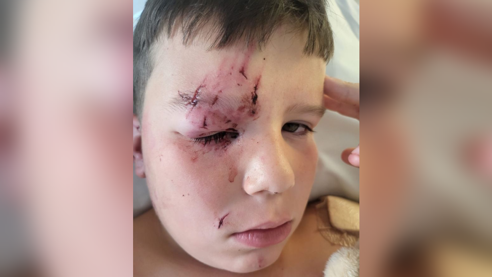 A close up picture of Caio with brown hair. He has scrapes and wounds all over his face and his right eye is swollen.