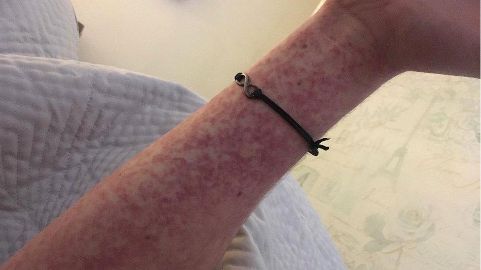 Luke Gardner's rubella rash