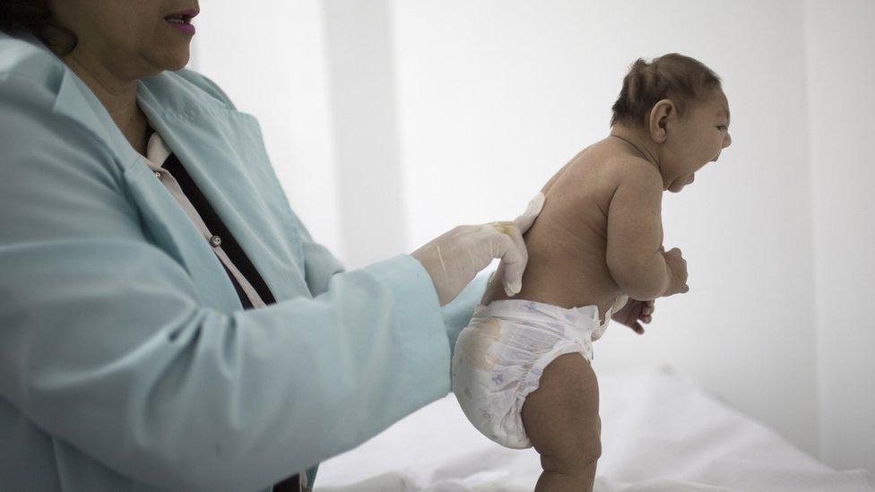 A baby from Brazil who has microcephaly