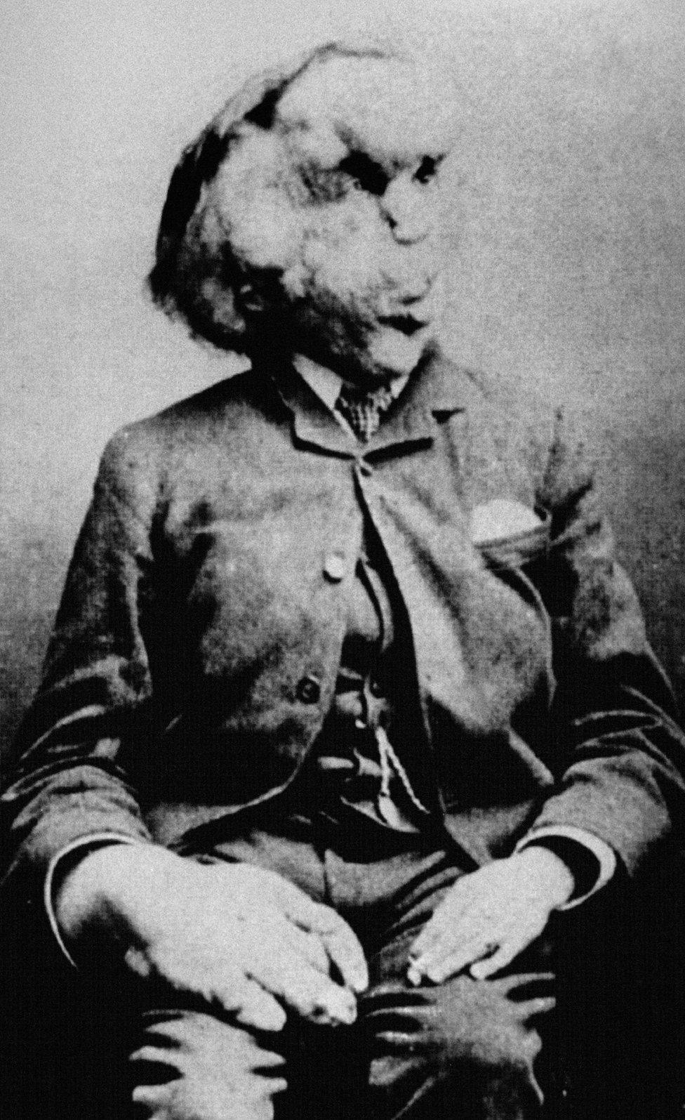 Joseph Carey Merrick, known as the Elephant Man, is shown in a photo from the Radiological Society of North America