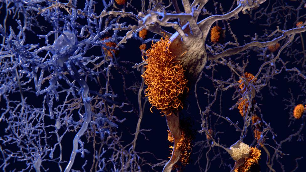 Neurons with amyloid plaques in Alzheimer's disease