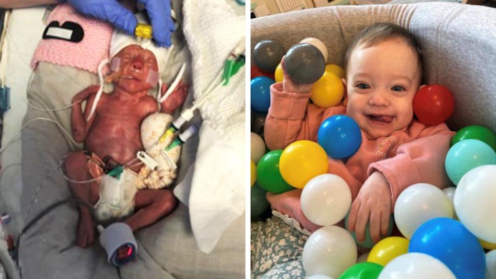 Martin Church's daughter Mabel in the neo natal unit and on the right, a pic of her as a healthy baby