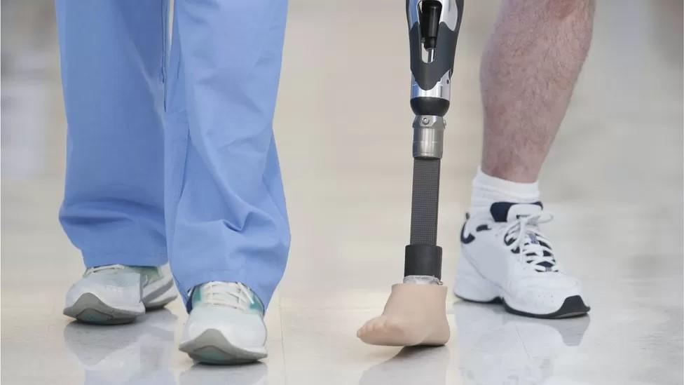 A doctor walking with a man with an amputated leg