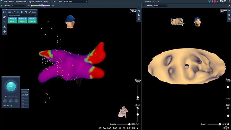 3D software showing atrial fibrillation