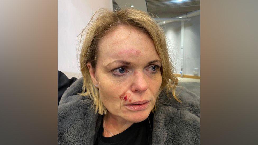 A woman with blonde hair and with cuts and bruises to her face. She is wearing a grey coat and a black top.