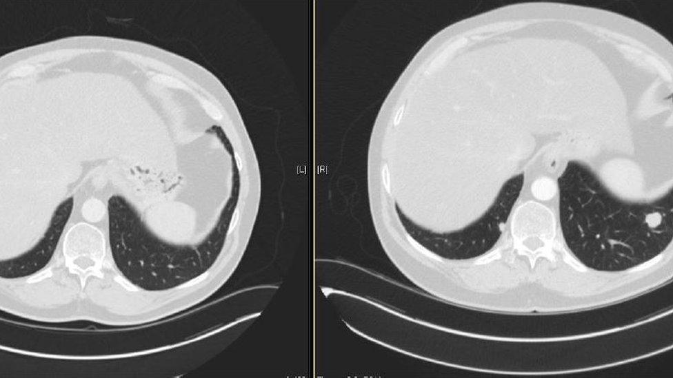 Scans of Mr Berry's lung with the cancer visible on the right scan